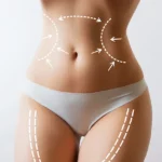 Why Vaser liposuction is such a popular procedure?