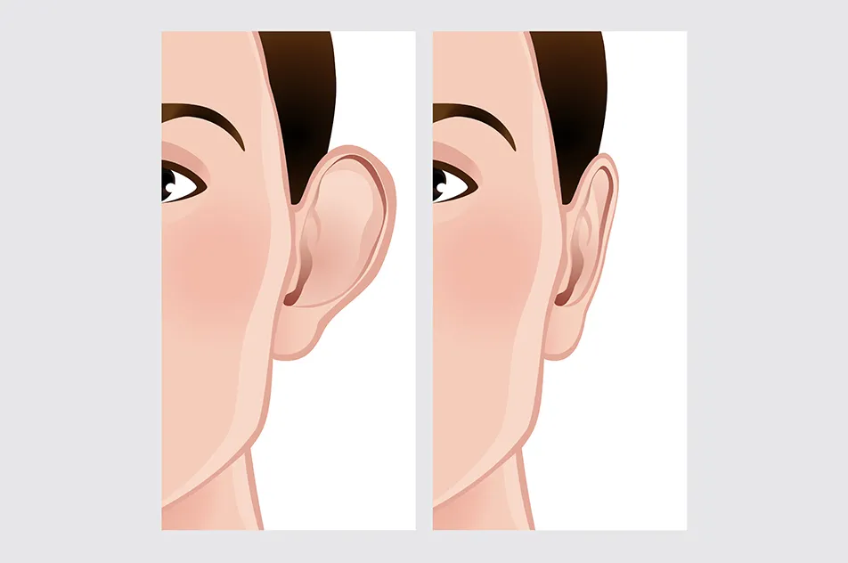 ear correction before and after