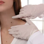 Mole Removal Options and Information