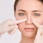 Rhinoplasty for Wide Nose: How Does It Work