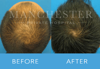 Hair Transplant Manchester | Hair Restoration | Hair Loss