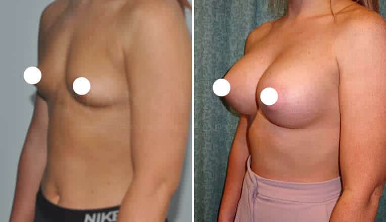 breast augmentation manchester before and after