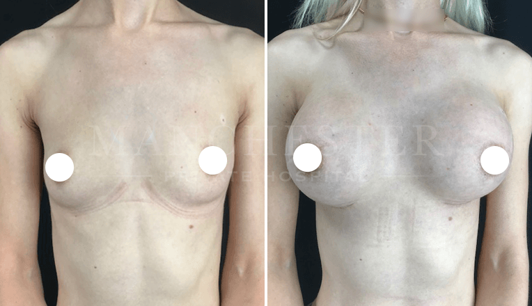 breast enlargement manchester before and after