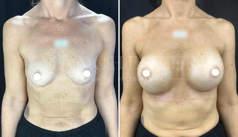 breast enlargement manchester before and after
