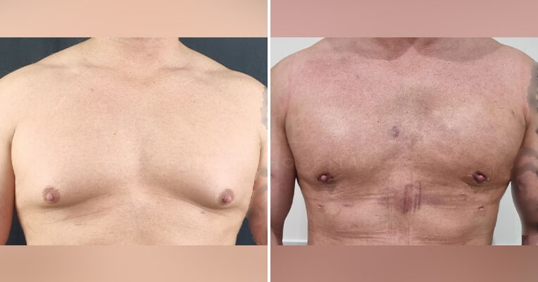 gynaecomastia surgery before and after