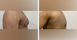 gynaecomastia surgery before and after