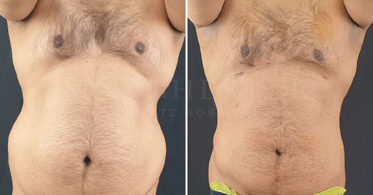 gynecomastia before and after surgery