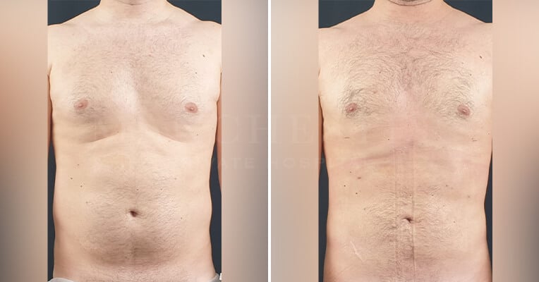 gynecomastia liposuction before and after