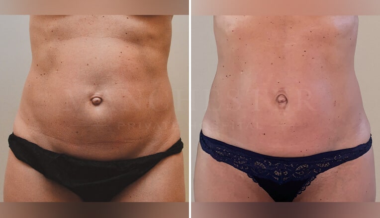 j plasma renuvion before and after