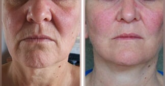 lower facelift before and after