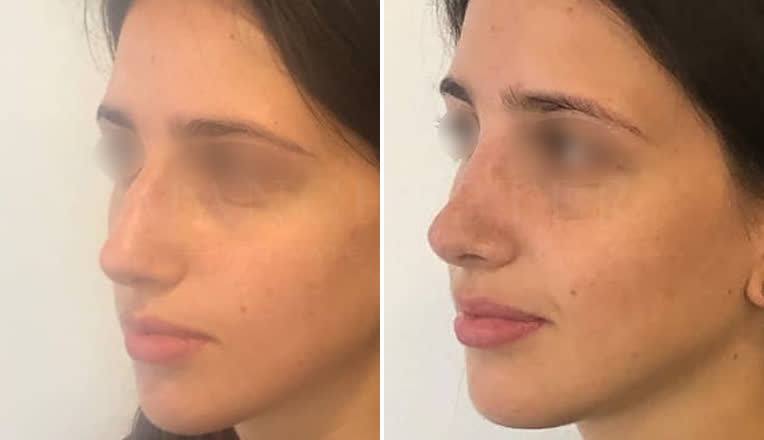 nose job before and after-2