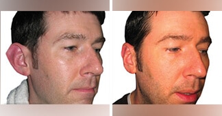 otoplasty surgery before and after