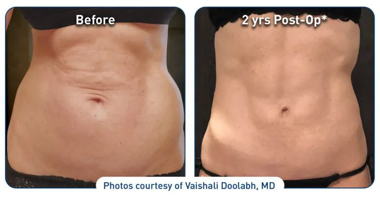 renuvion-before-after-abdominal-case-1-photos_front_72dpi-768x405.jpg