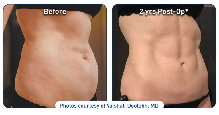 renuvion-before-after-abdominal-case-1-photos_right-side-72dpi-768x405.jpg