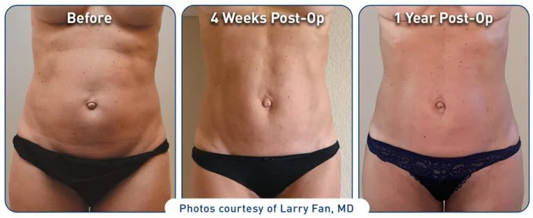 renuvion_before-after_abdominal-case3_photos_062320_front_72dpi-768x315.jpg