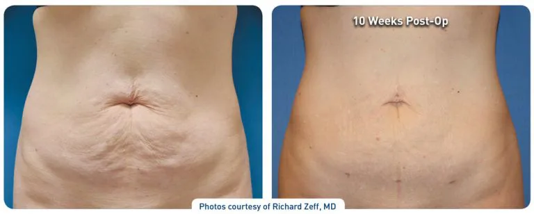 renuvion_before-after_abdominal-case4_photos-front_72dpi-768x308.jpg