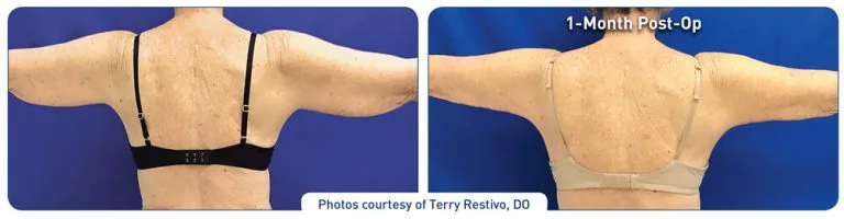 renuvion_before-after_arms2-photos_back-72dpi-768x200.jpg