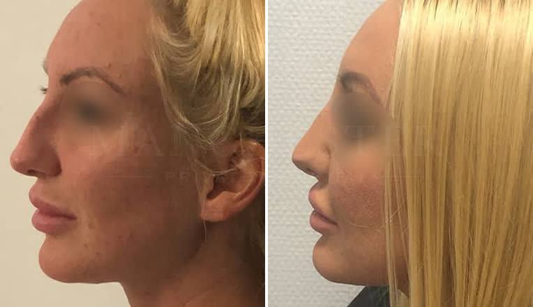 rhinoplasty surgery before and after result