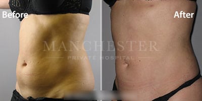 stomach vaser liposuction before and after