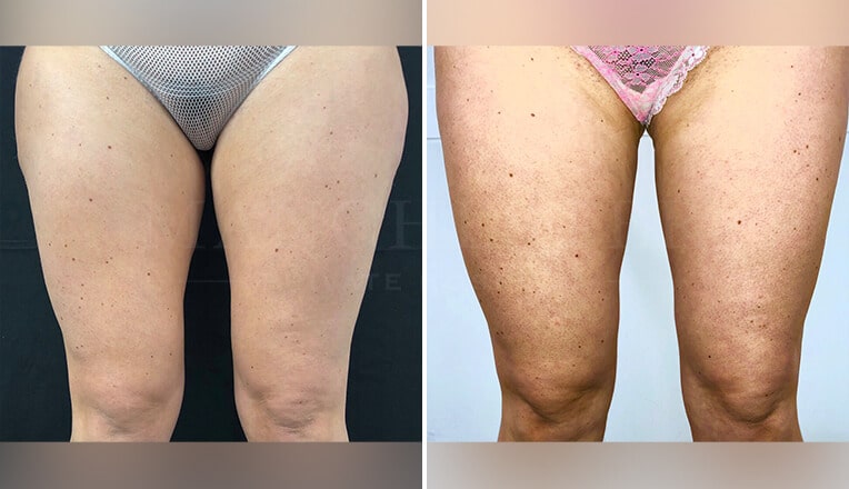 thigh liposuction before and after