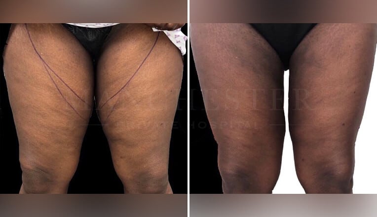 thigh vaser liposuction before and after