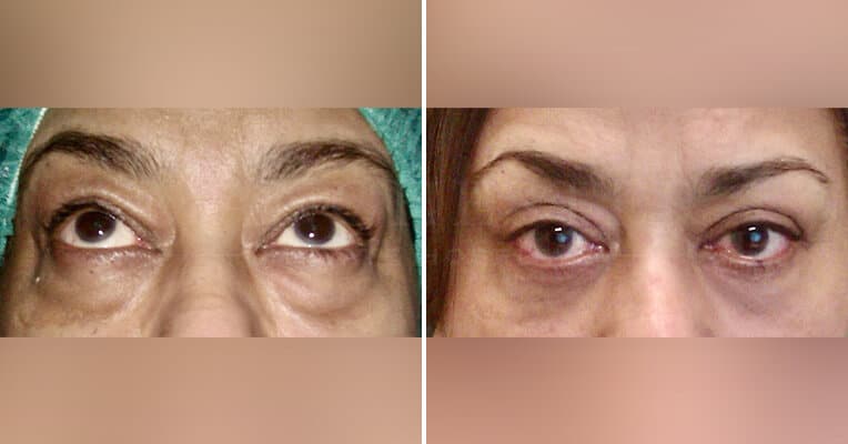 under eye blepharoplasty before and afte