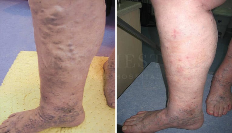 varicose vein surgery before and after