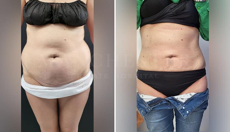 vaser lipo before and after stomach