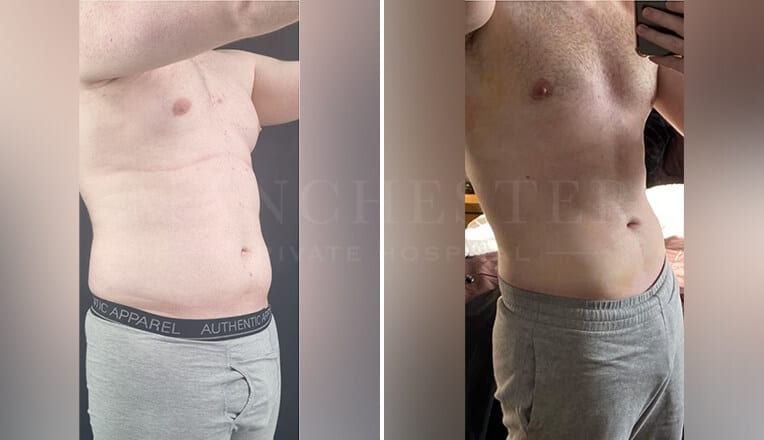 vaser lipo high definition before and after