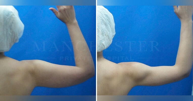 vaser lipo on arms before and after