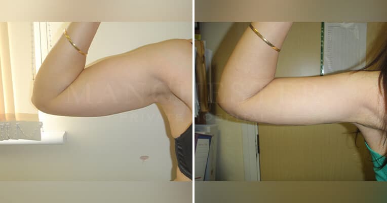 vaser liposuction arms before and after