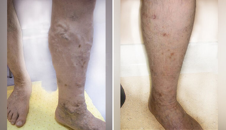 vericose vein before and after
