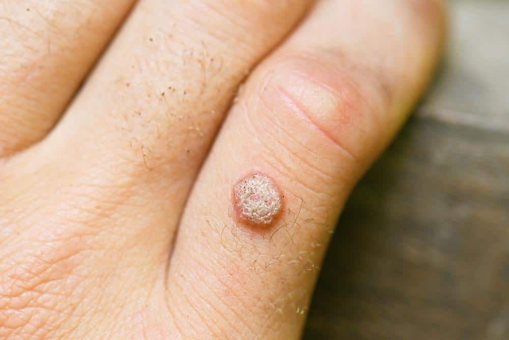 Wart Removal In Manchester