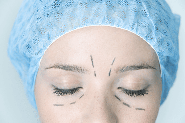 blepharoplasty - eyelid surgery
