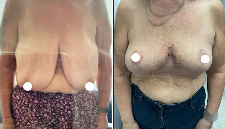 breast reduction surgery before and after results.