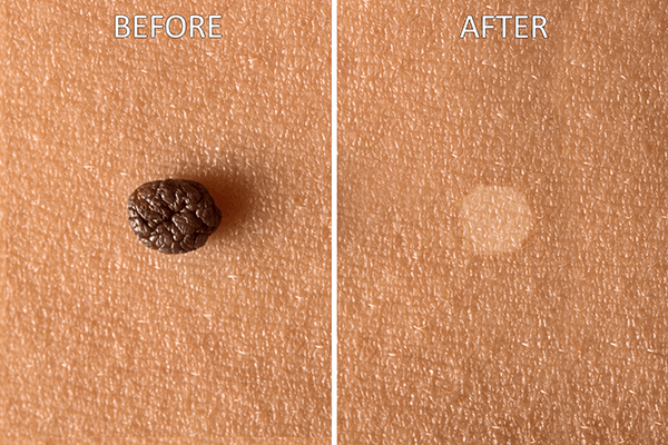 mole removal before and after