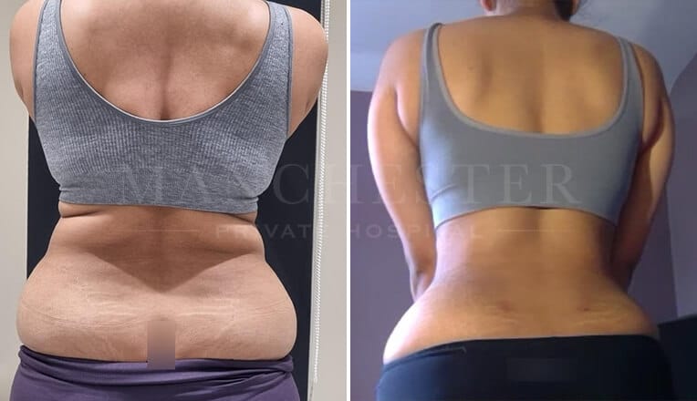 back vaser liposuction before and after by mr fiore-2