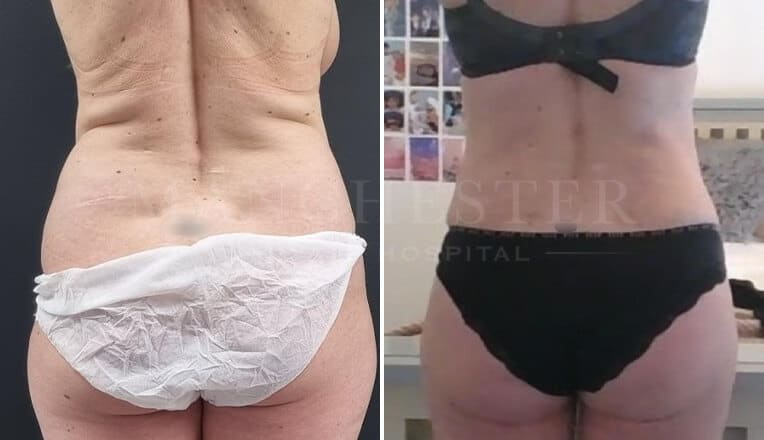 back vaser liposuction before and after by mr fiore-3