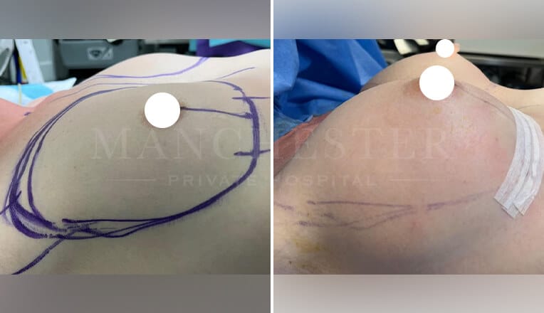 breast augmentation before and after by mr mehdi 3