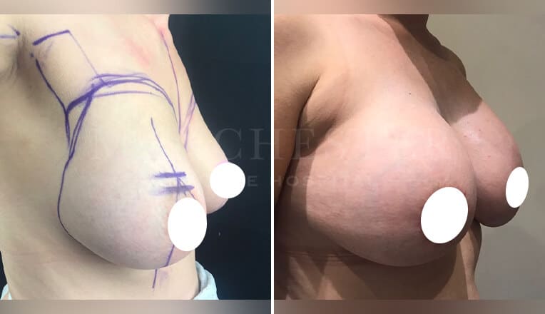 breast augmentation before and after by mr mehdi 7