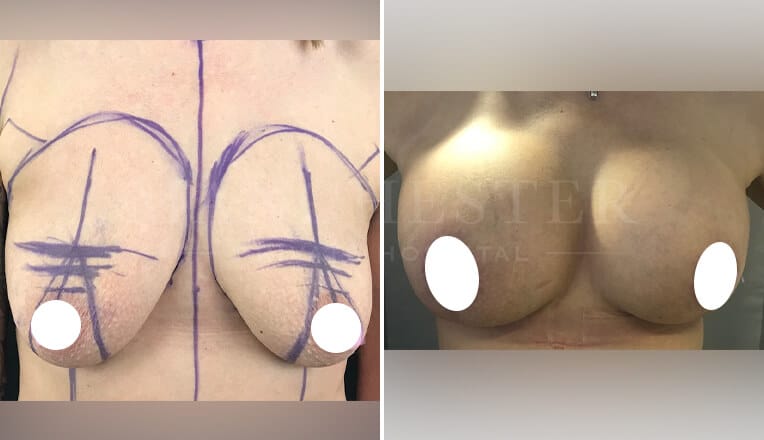 breast augmentation before and after by mr mehdi 8