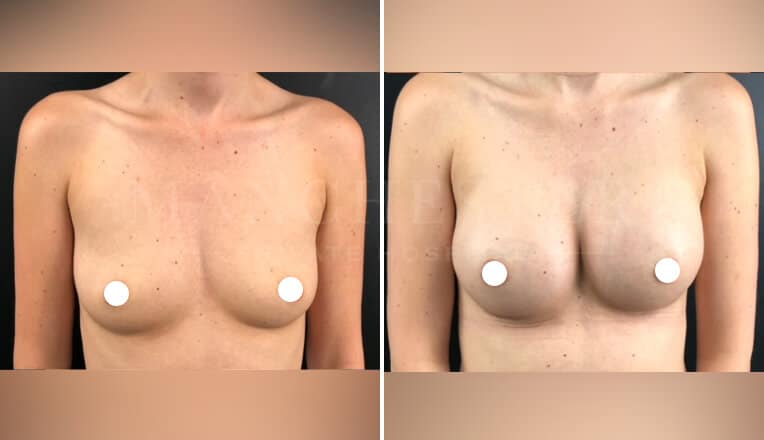 breast augmentation before and after by mr molajo
