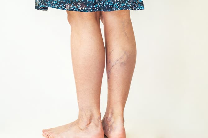 varicose vein removal manchester