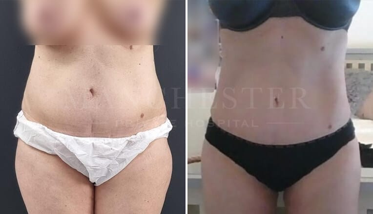 vaser lipo before and after stomach by mr fiore-2