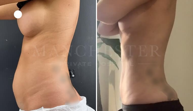 vaser liposuction before and after by mr fiore