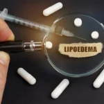 What is lipoedema?