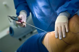 What is liposuction?