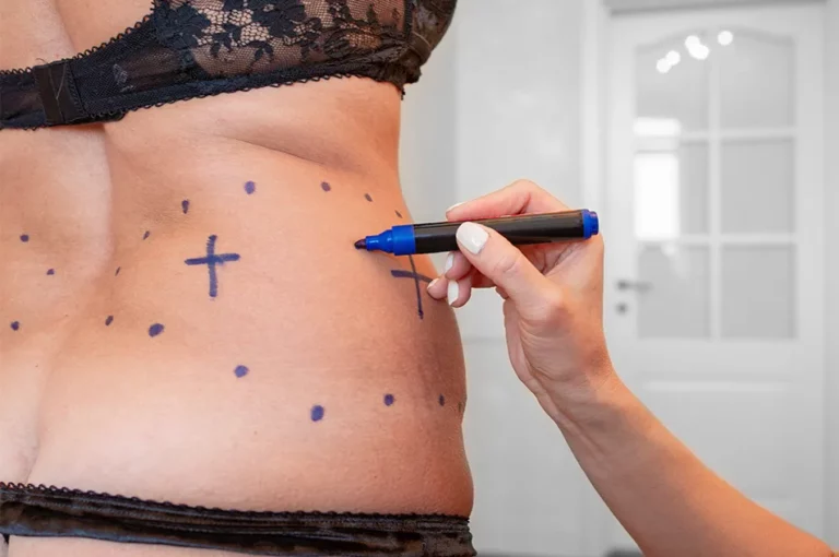 a liposuction surgeon marks out where incisions will be made on a woman’s abdomen