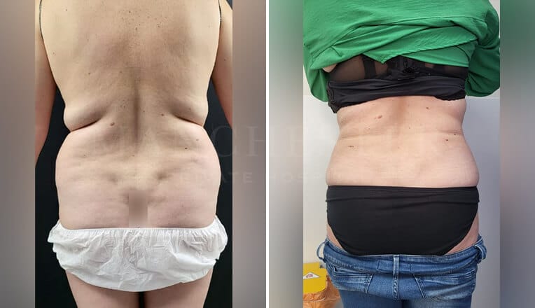 liposuction lower and mid back before and after