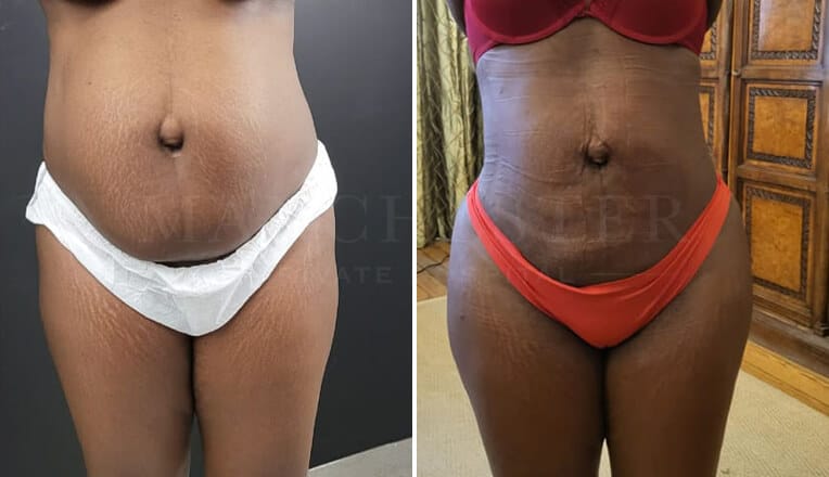 liposuction stomach before and after